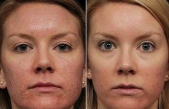 Láser rejuvenece la cara antes y después
