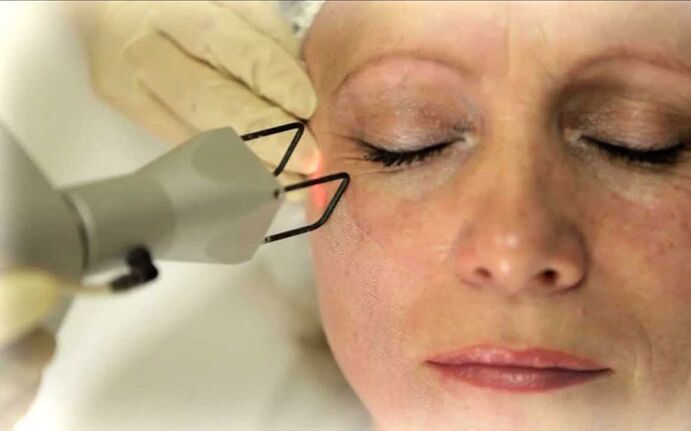 Eliminación láser de arrugas alrededor de los ojos.